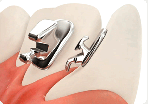 Aparat Dentar Lingual STB